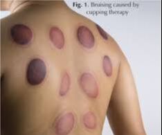 cupping gone wrong